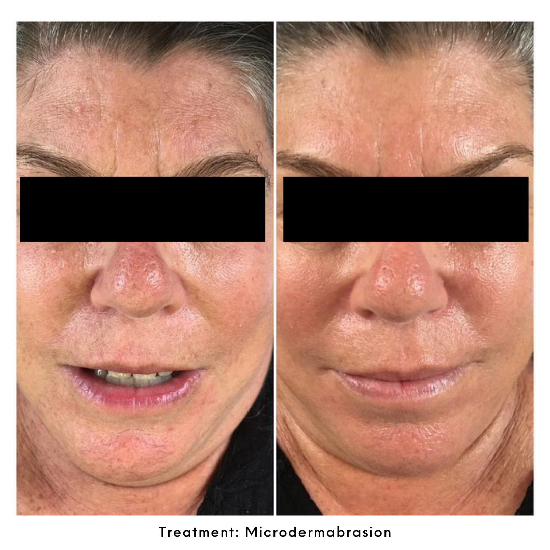 before and after image of the treatment